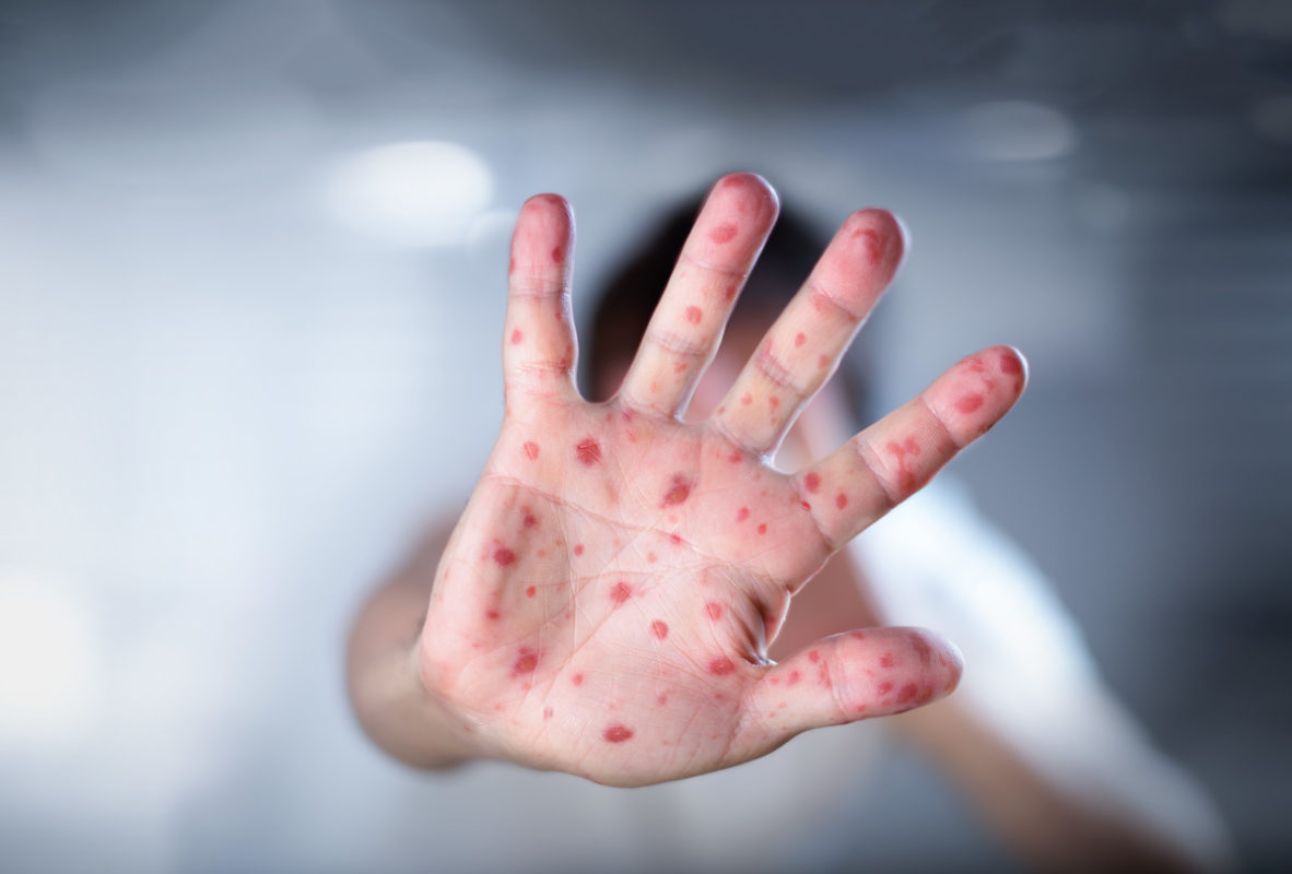 El peor brote de sarampión desde 1994 llega a 26 estados en EU