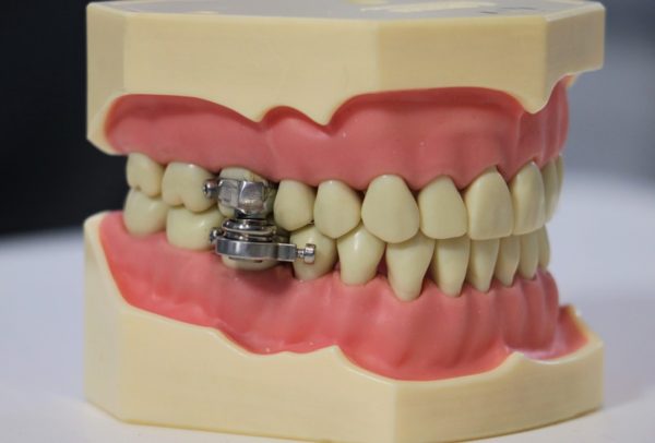 Crean el primer “candado” de dientes para adelgazar